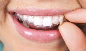 ارتودنسی نامرئی یا invisible orthodontics