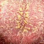 آیا عوامل ژنتیکی و ویروسی یا محیطی در بروز آن نقش دارد؟