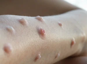 کهیر (Urticaria)؛ علل، انواع و راه‌های درمان