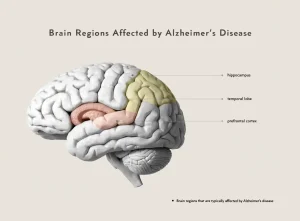 آلزایمر؛ مراحل پیشرفت بیماری و راهنمای مراقبت از بیمار