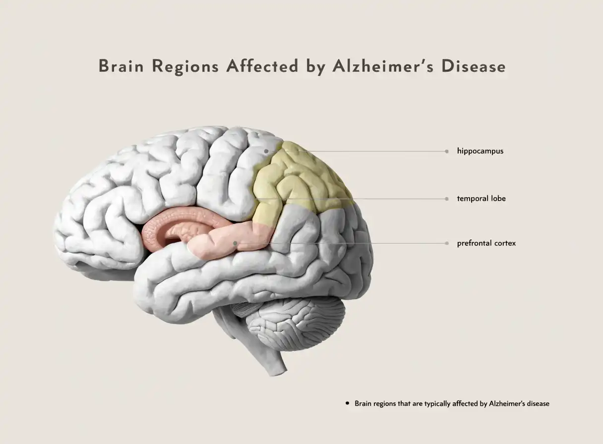 آلزایمر؛ مراحل پیشرفت بیماری و راهنمای مراقبت از بیمار