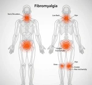 فیبرومیالژیا (Fibromyalgia) | علائم، علل، تشخیص و درمان سندرم درد مزمن