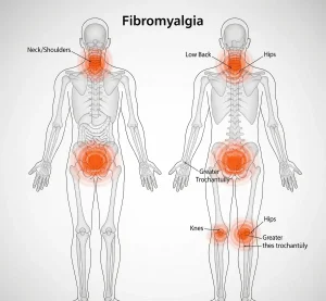 فیبرومیالژیا (Fibromyalgia) | علائم، علل، تشخیص و درمان سندرم درد مزمن