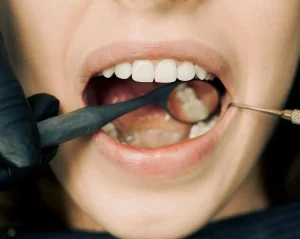 پریودنتولوژی چیست؟ راهنمای جامع پیشگیری و درمان بیماری های لثه