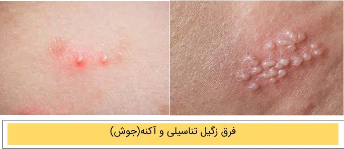 فرق بین آکنه و زگیل تناسیلی