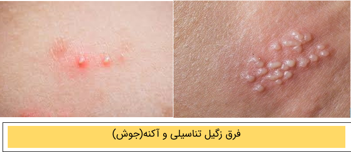فرق بین آکنه و زگیل تناسیلی