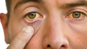 سندرم ژیلبرت چیست؟علل، علائم، تشخیص و درمان