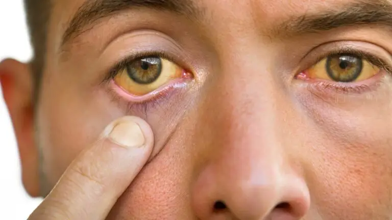 سندرم ژیلبرت چیست؟علل، علائم، تشخیص و درمان