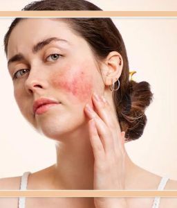 لوپوس در کودکان و نوجوانان: علائم، تشخیص، درمان و نکات کلیدی پیش‌آگهی