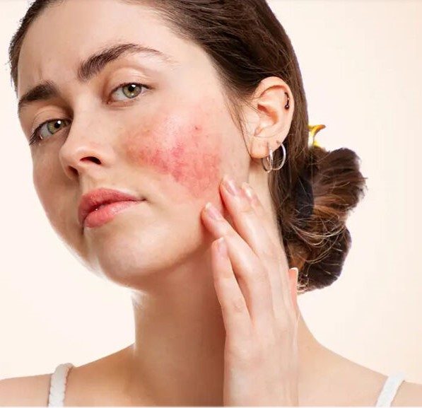 لوپوس در کودکان و نوجوانان: علائم، تشخیص، درمان و نکات کلیدی پیش‌آگهی