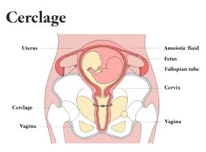 سرکلاژ دهانه رحم (Cervical Cerclage) چیست؟