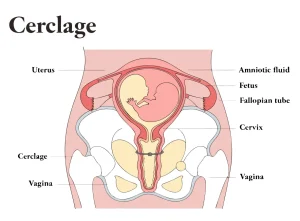 سرکلاژ دهانه رحم (Cervical Cerclage) چیست؟