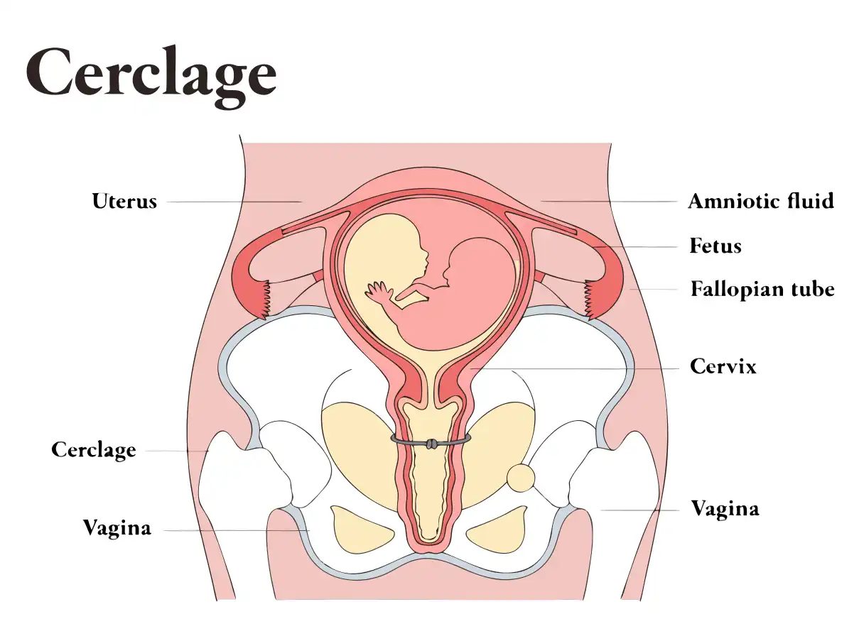 سرکلاژ دهانه رحم (Cervical Cerclage) چیست؟ سرکلاژ دهانه رحم (Cervical Cerclage) چیست؟