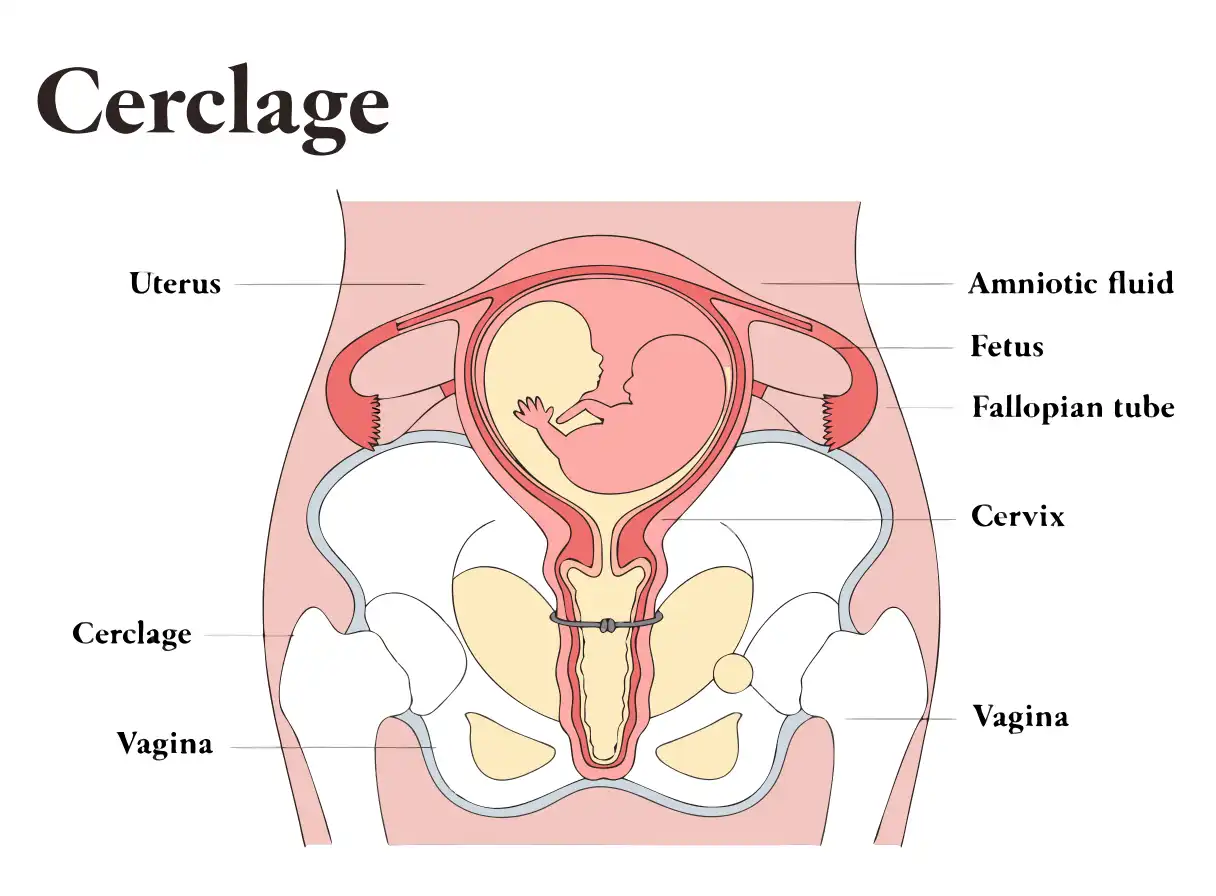 سرکلاژ دهانه رحم (Cervical Cerclage) چیست؟