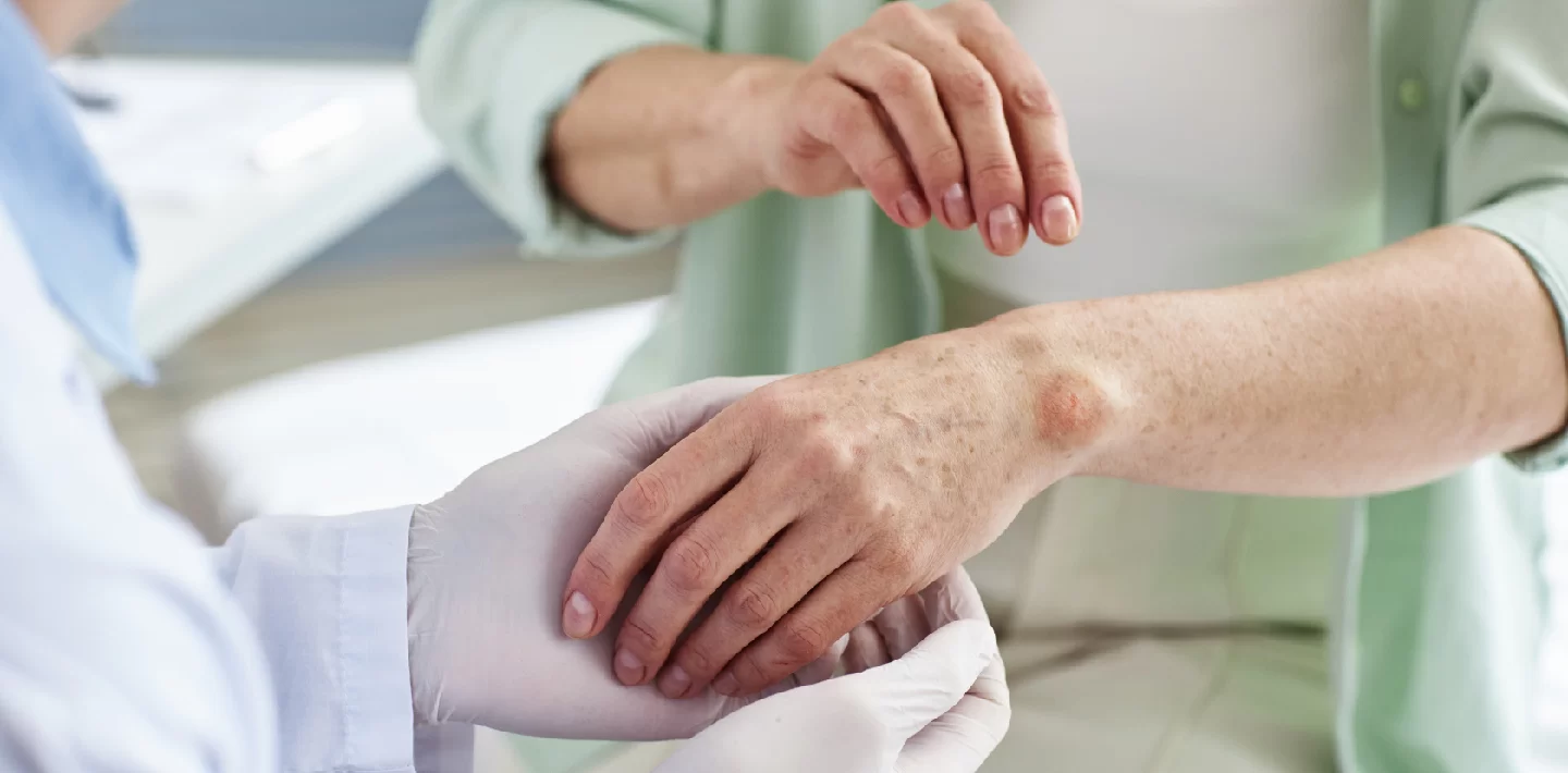 بیماری‌های خودایمنی