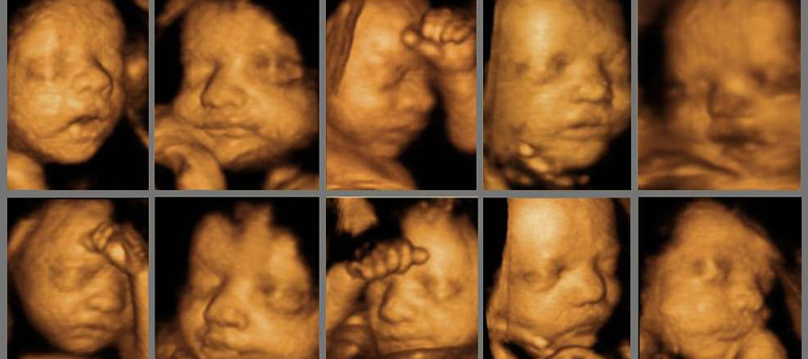 سونوگرافی داپلر در بارداری