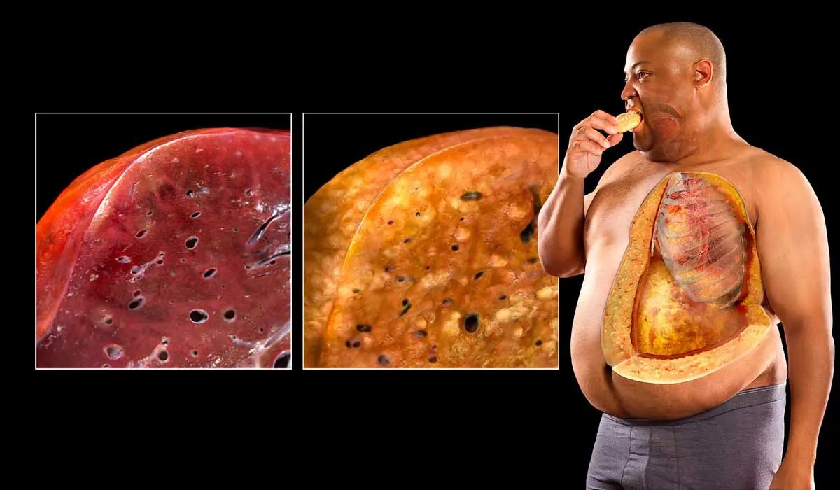 رژیم درمانی کبد چرب چیست و چه تاثیری دارد؟