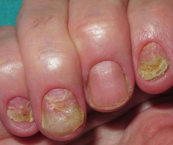 آیا کاشت ناخن باعث سرطان میشود؟