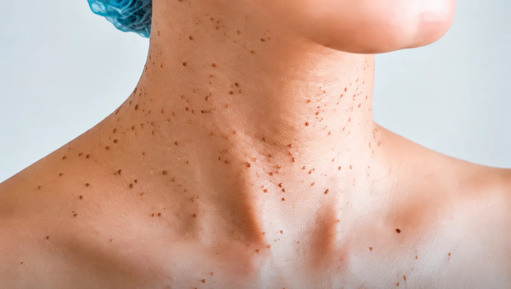 خال قرمز روی بدن نشانه چیست؟ علت زیاد شدن، انواع و زمان مراجعه به پزشک