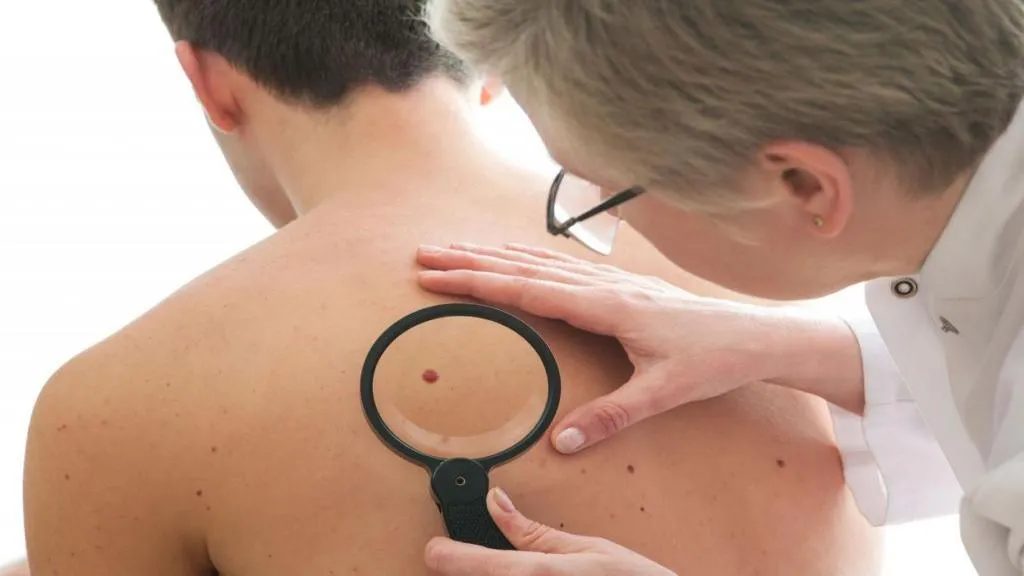 پزشک در حال بررسی خال قرمز روی پوست پشت بیمار با ذره‌بین