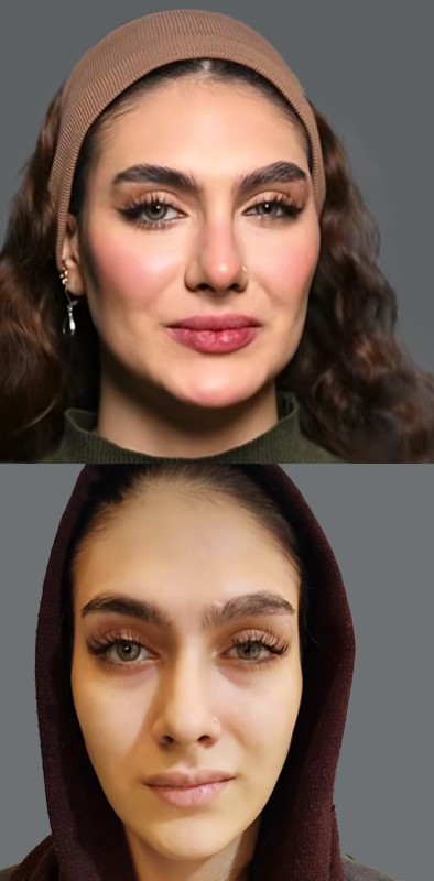 بهترین تزریق ژل برای صورت کشیده