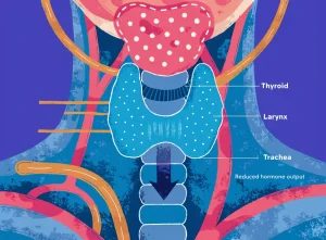 کم‌کاری تیروئید (Hypothyroidism)؛ علائم، تشخیص و درمان