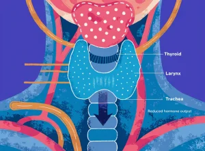 کم‌کاری تیروئید (Hypothyroidism)؛ علائم، تشخیص و درمان