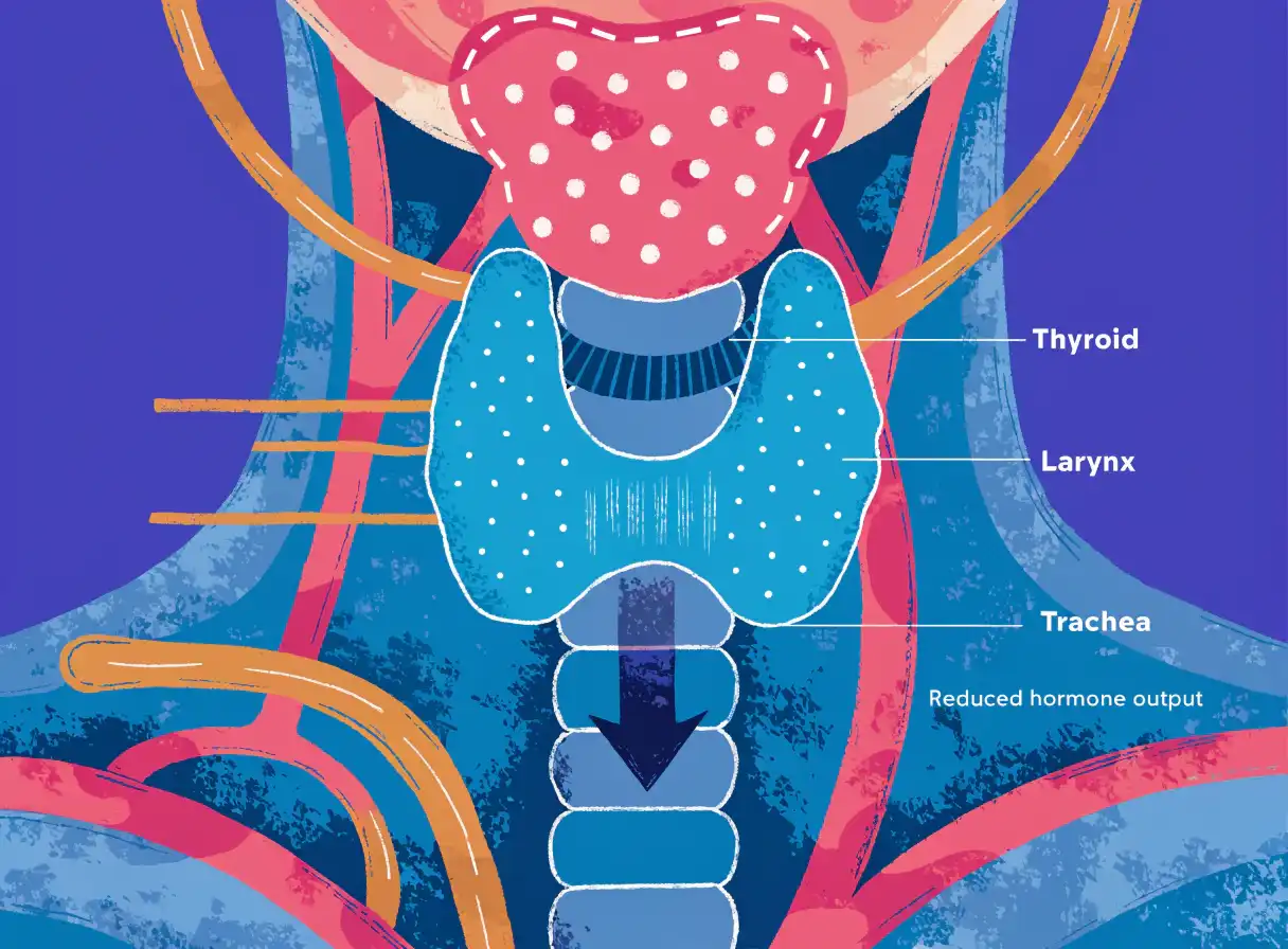 کم‌کاری تیروئید (Hypothyroidism)؛ علائم، تشخیص و درمان