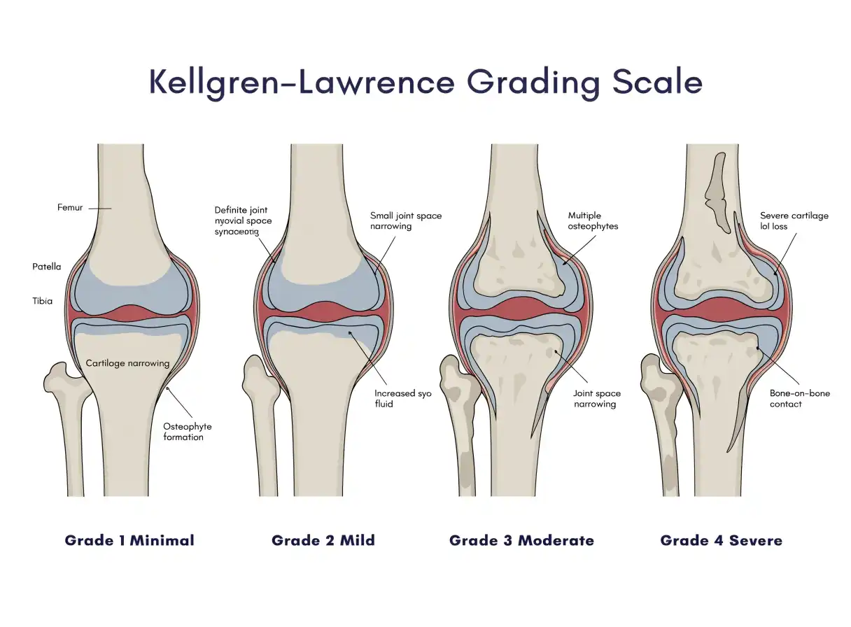 درجه‌بندی رادیوگرافیک Kellgren-Lawrence 