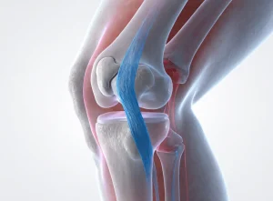 پارگی رباط صلیبی قدامی زانو و بازسازی آن (ACL Tear & Reconstruction)