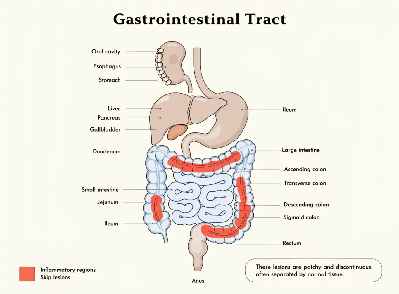 بیماری کرون (Crohn’s Disease) چیست؟
