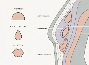 پروتز و بزرگ کردن سینه (Breast Augmentation)؛ آنچه باید پیش از تصمیم‌گیری بدانید