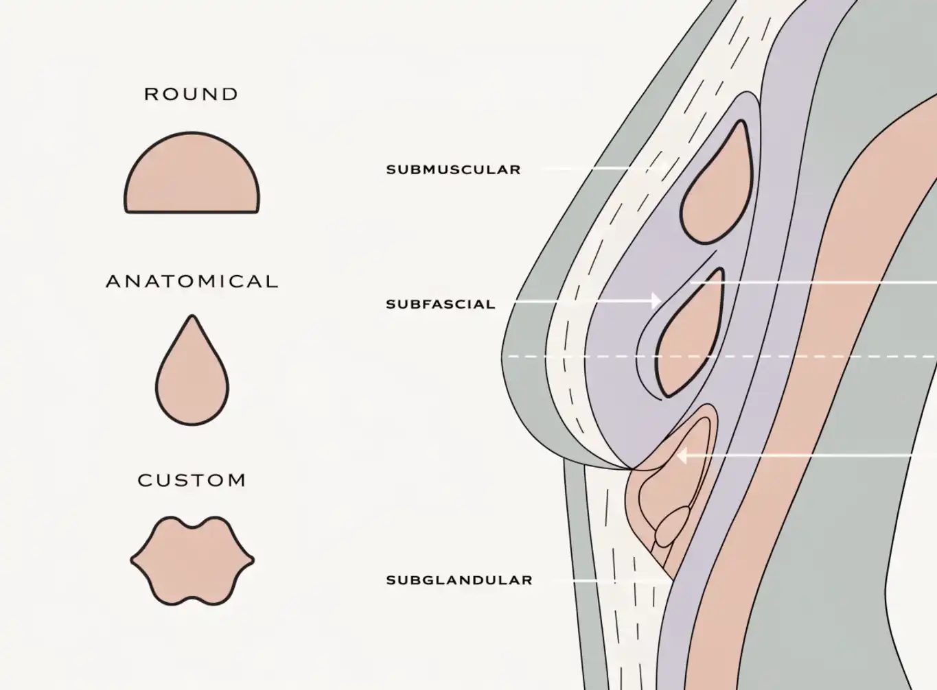 پروتز و بزرگ کردن سینه (Breast Augmentation)؛ آنچه باید پیش از تصمیم‌گیری بدانید