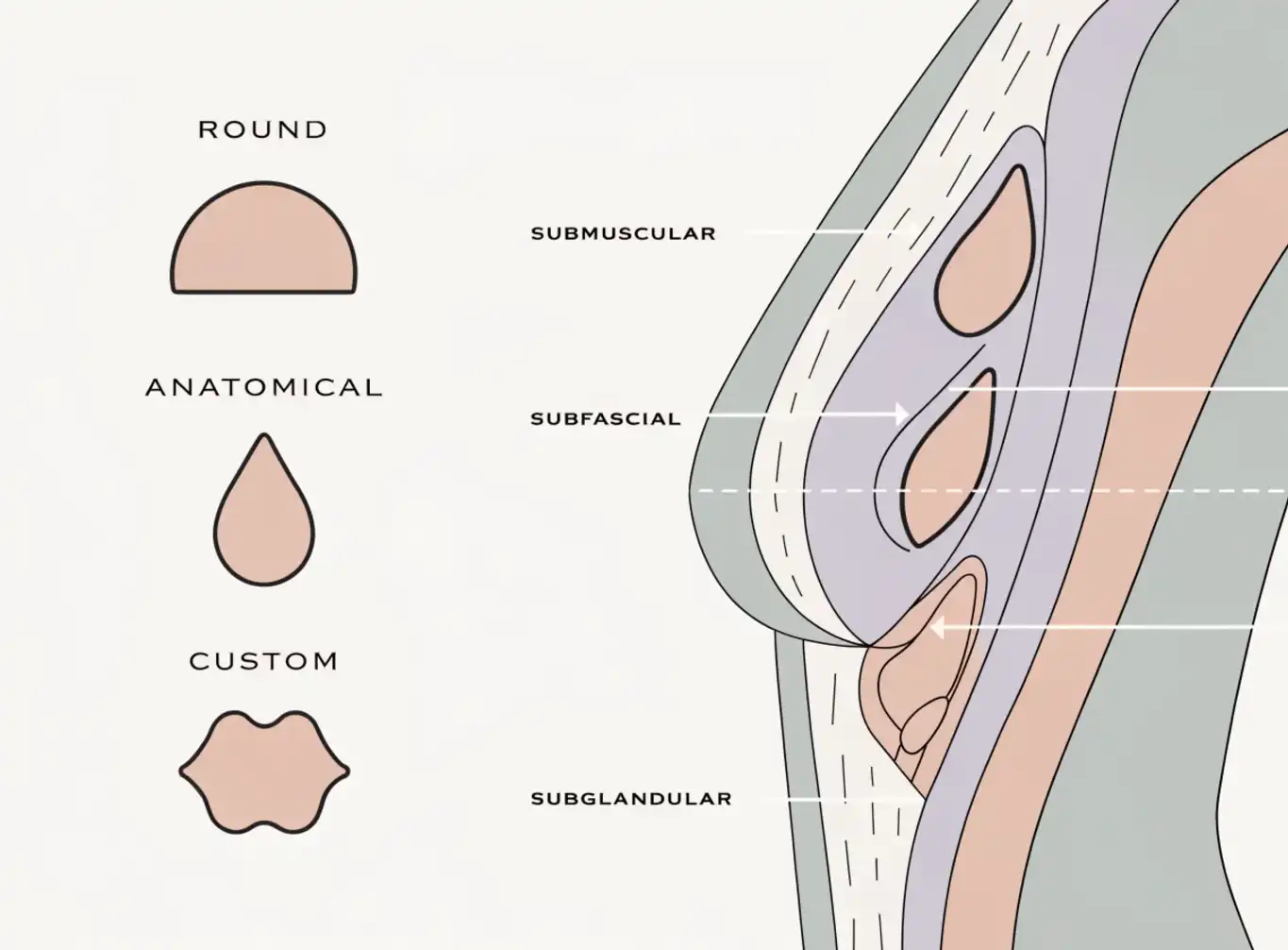 پروتز و بزرگ کردن سینه (Breast Augmentation)؛ آنچه باید پیش از تصمیم‌گیری بدانید