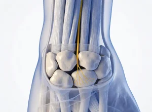 سندرم تونل کارپال (Carpal Tunnel Syndrome)