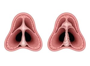 انحراف تیغهٔ بینی (Deviated Nasal Septum) چیست؟