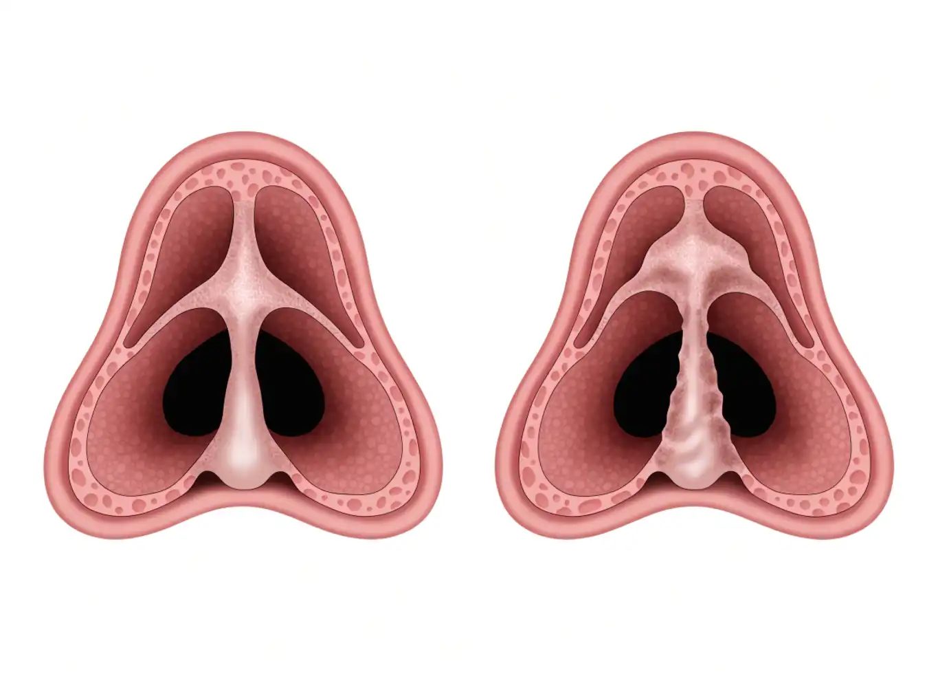 انحراف تیغهٔ بینی (Deviated Nasal Septum) چیست؟