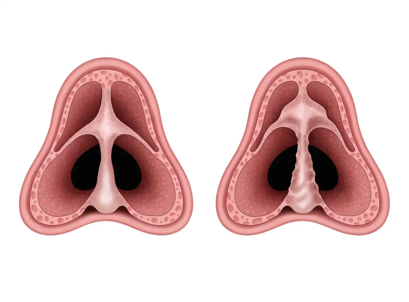 انحراف تیغهٔ بینی (Deviated Nasal Septum) چیست؟