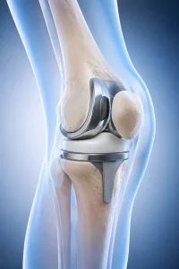 تعویض مفصل زانو (Knee Replacement / Total Knee Arthroplasty)
