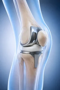 تعویض مفصل زانو (Knee Replacement / Total Knee Arthroplasty)
