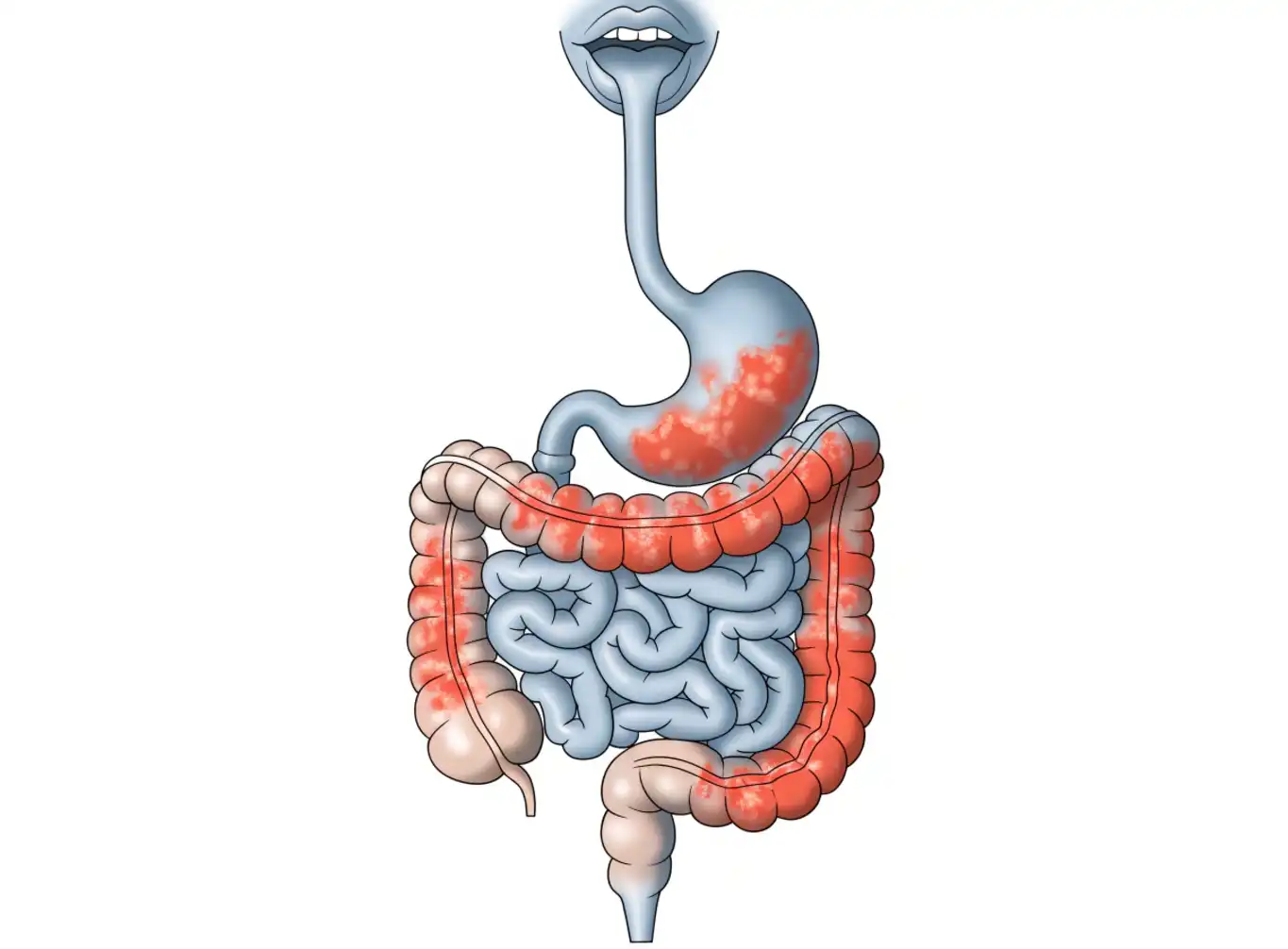 کولیت اولسراتیو (Ulcerative Colitis) چیست؟