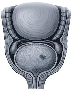 سرطان پروستات (Prostate Cancer) چیست؟