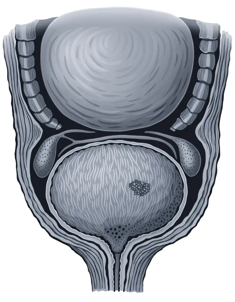 سرطان پروستات (Prostate Cancer) چیست؟