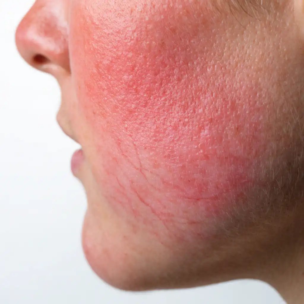 روزاسه (گل‌گونگی صورت) چیست؟ علائم، انواع و اصول کنترل آن