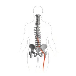 سیاتیک چیست؟ علائم، علل و زمان مراجعه اورژانسی