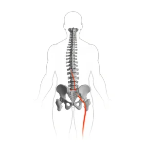 سیاتیک چیست؟ علائم، علل و زمان مراجعه اورژانسی