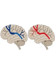 سکته مغزی (Stroke): علائم هشدار، انواع و اقدام فوری
