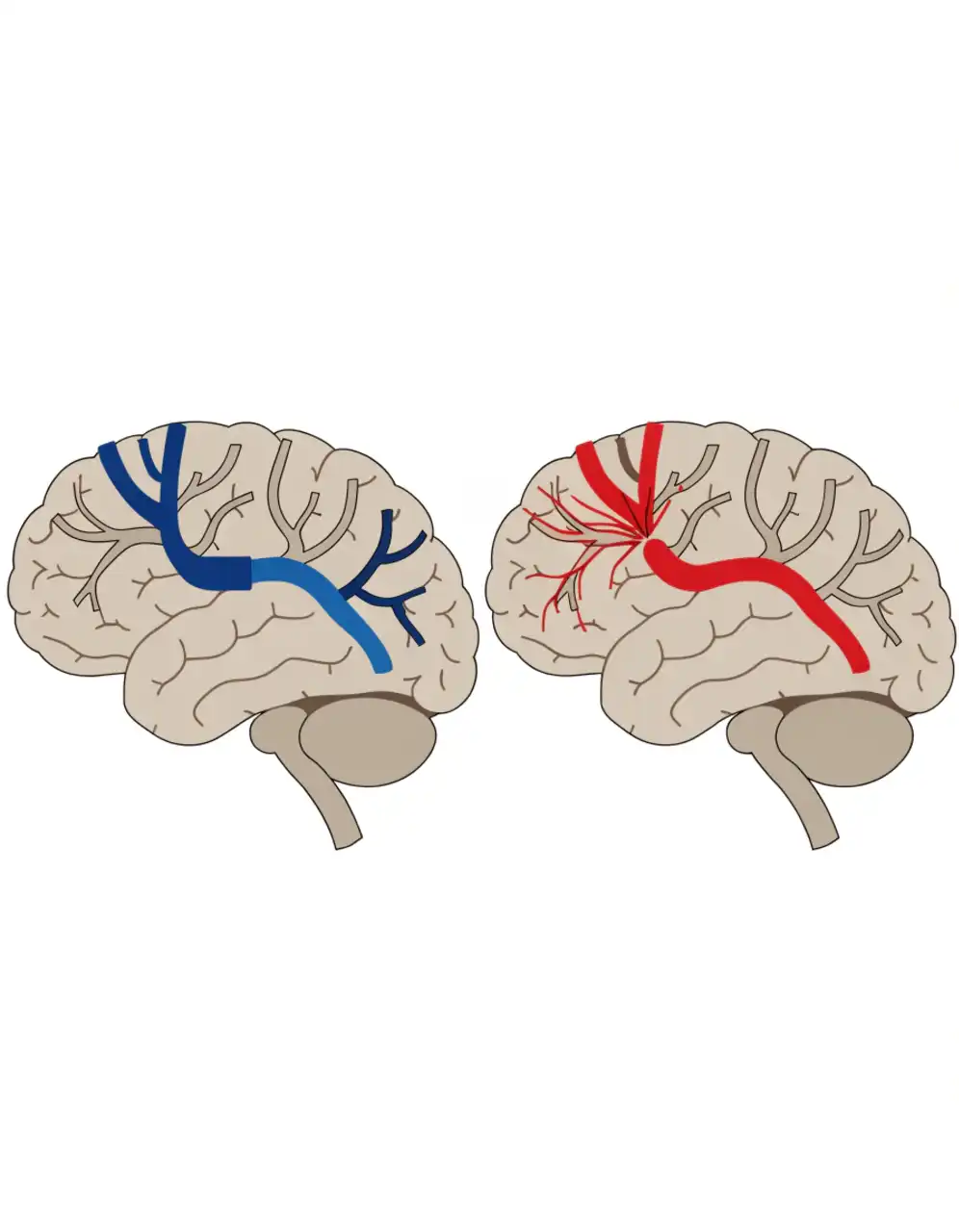 سکته مغزی (Stroke): علائم هشدار، انواع و اقدام فوری