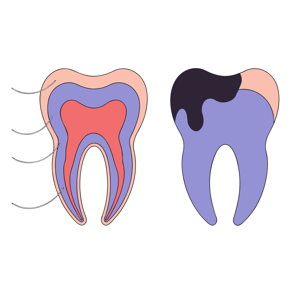 پوسیدگی دندان (Tooth Decay / Dental Caries) چیست؟