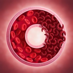 کم‌خونی داسی‌شکل (Sickle Cell Disease) چیست؟